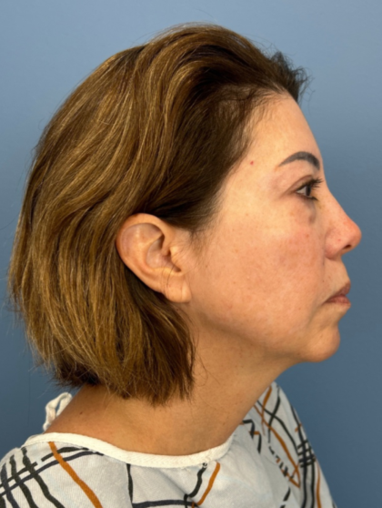 Facial Fat Grafting Before & After Patient #15857