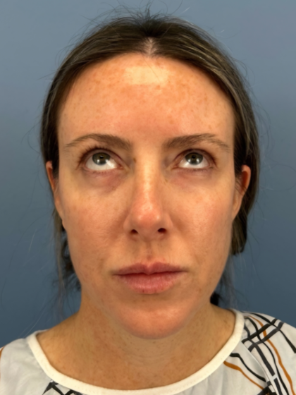 Browlift Before & After Patient #15868