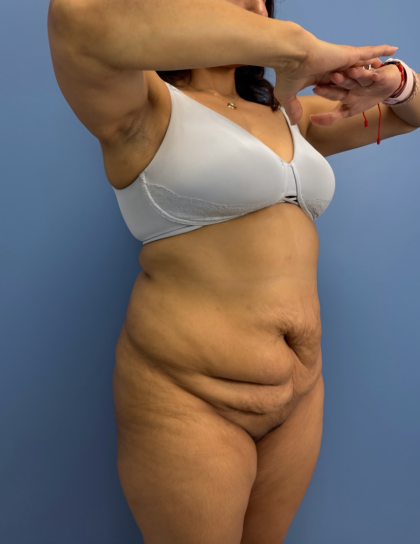 Lower Body Lift Before & After Patient #15802