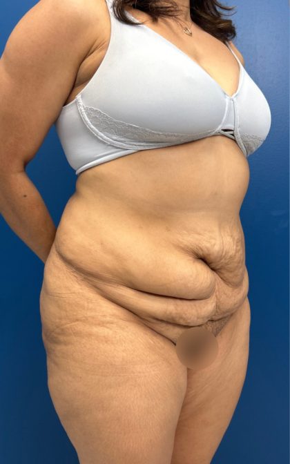 Tummy Tuck Before & After Patient #15804