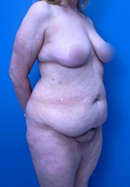 Lower Body Lift Before & After Patient #15924