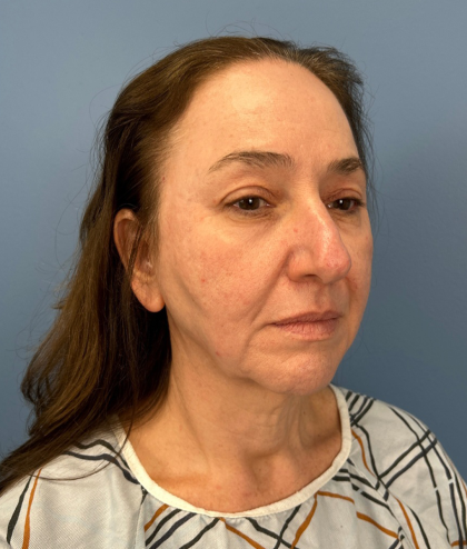 Facial Fat Grafting Before & After Patient #15978