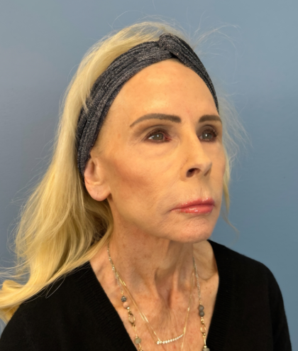 Facial Fat Grafting Before & After Patient #15993
