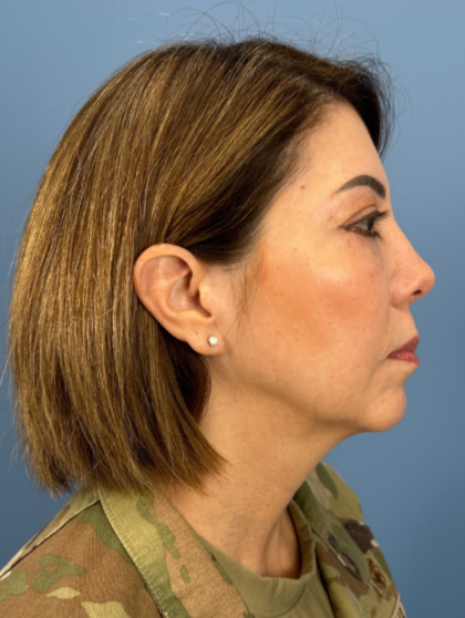 Facial Fat Grafting Before & After Patient #15857