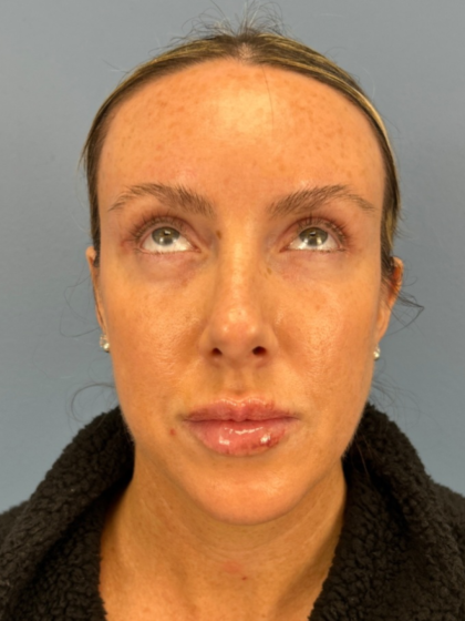 Browlift Before & After Patient #15868