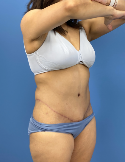 Lower Body Lift Before & After Patient #15802