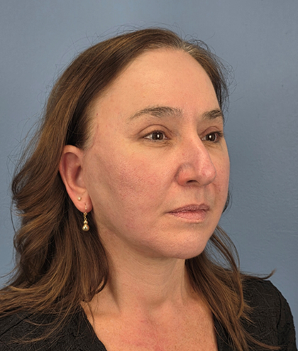 Facial Fat Grafting Before & After Patient #15978