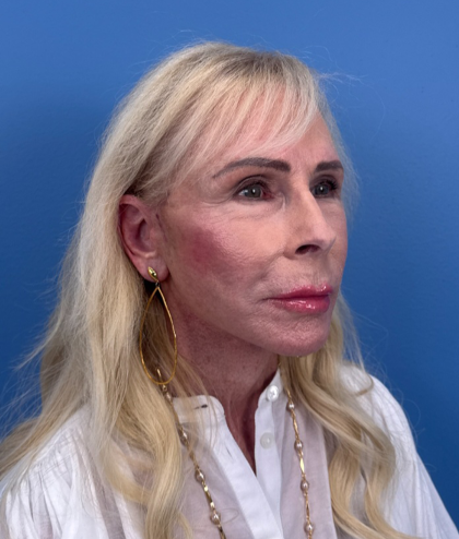 Facial Fat Grafting Before & After Patient #15993