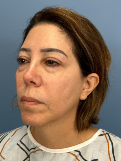 Facial Fat Grafting Before & After Patient #15857