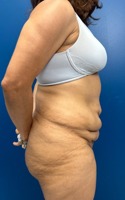 Lower Body Lift Before & After Patient #15802