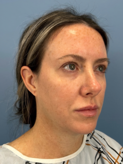 Browlift Before & After Patient #15868