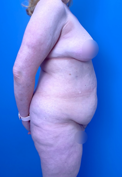 Lower Body Lift Before & After Patient #15924
