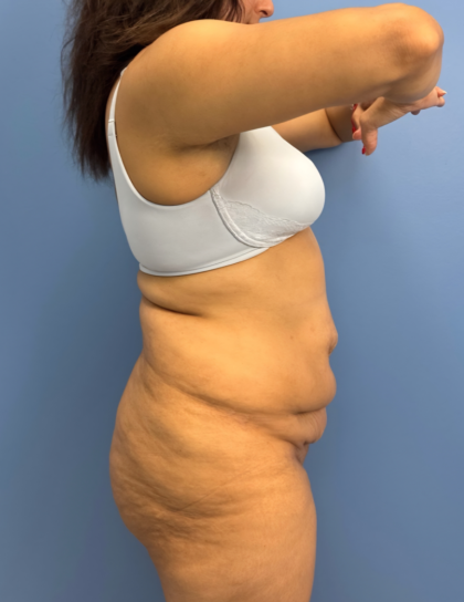 Lower Body Lift Before & After Patient #15802
