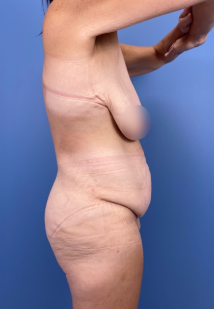 Lower Body Lift Before & After Patient #15939