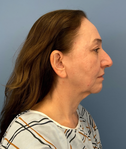 Facial Fat Grafting Before & After Patient #15978