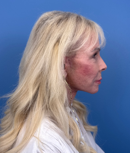 Facial Fat Grafting Before & After Patient #15993
