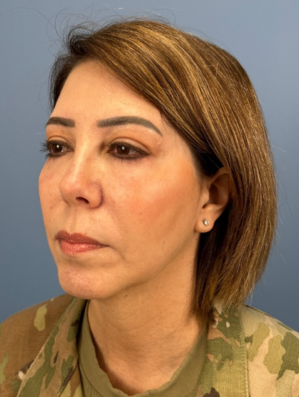 Facial Fat Grafting Before & After Patient #15857
