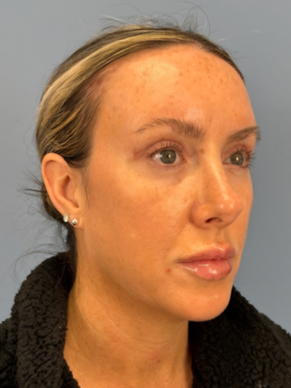 Browlift Before & After Patient #15868