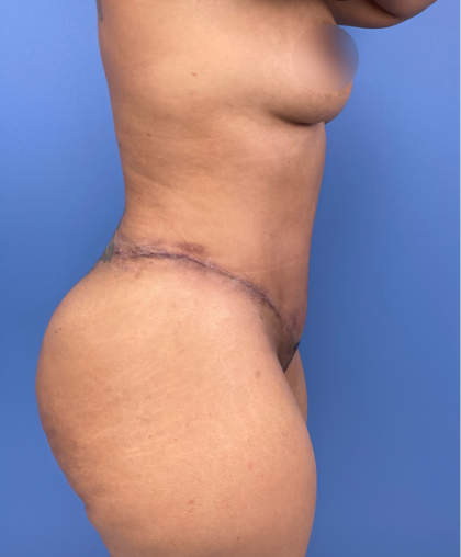 Tummy Tuck Before & After Patient #15911
