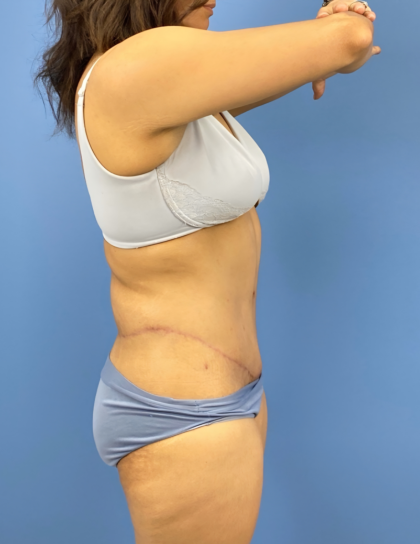 Lower Body Lift Before & After Patient #15802