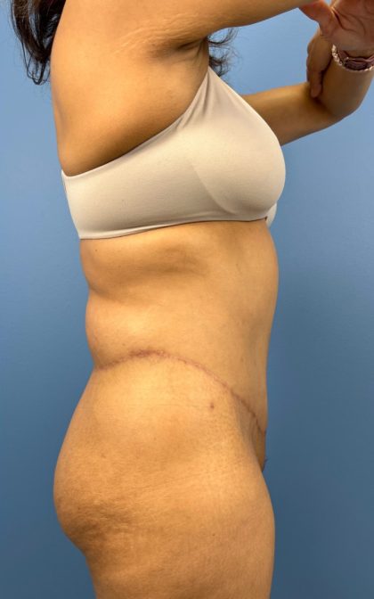 Tummy Tuck Before & After Patient #15804