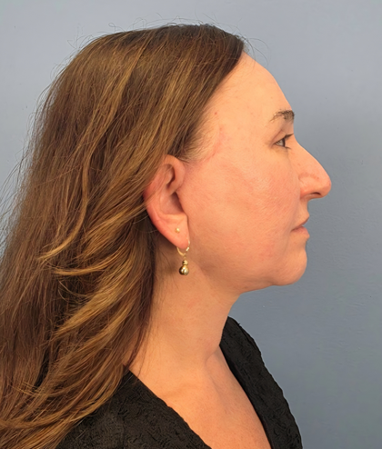 Facial Fat Grafting Before & After Patient #15978