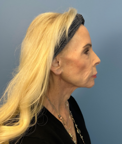 Facial Fat Grafting Before & After Patient #15993