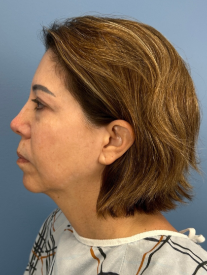 Facial Fat Grafting Before & After Patient #15857
