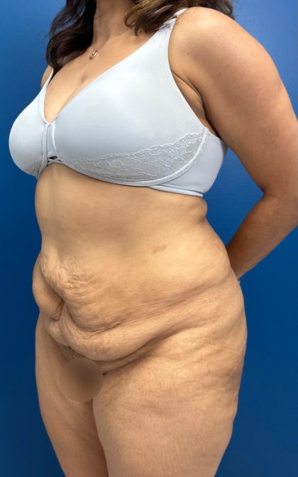 Lower Body Lift Before & After Patient #15802