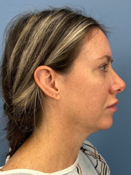 Blepharoplasty Before & After Patient #15869
