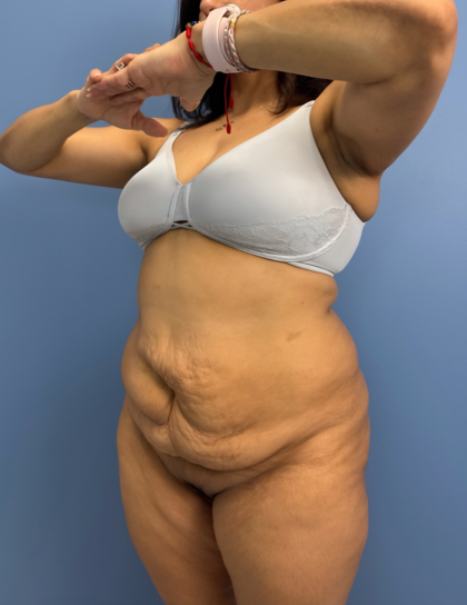Lower Body Lift Before & After Patient #15802