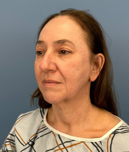 Facial Fat Grafting Before & After Patient #15978