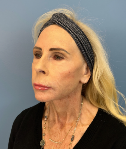 Facial Fat Grafting Before & After Patient #15993