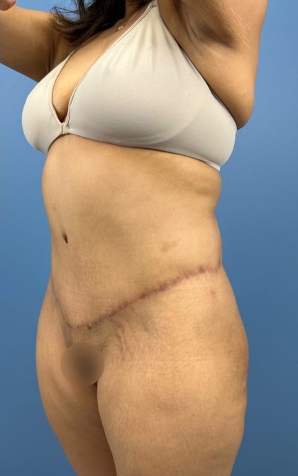 Lower Body Lift Before & After Patient #15802