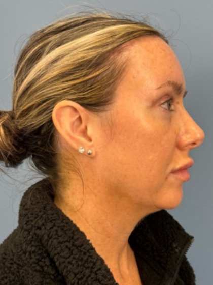 Blepharoplasty Before & After Patient #15869