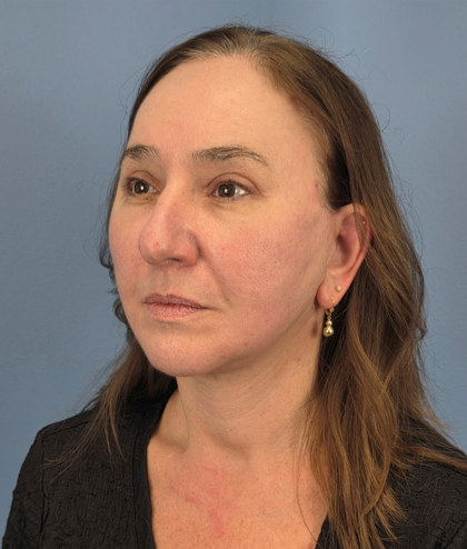 Facial Fat Grafting Before & After Patient #15978