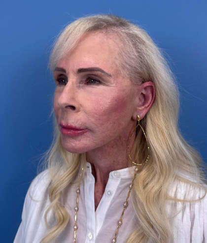 Facial Fat Grafting Before & After Patient #15993