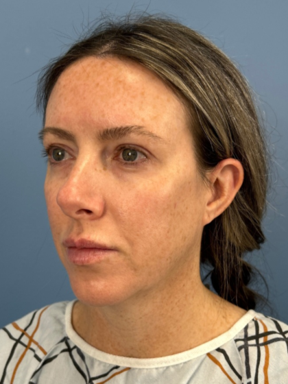 Blepharoplasty Before & After Patient #15869