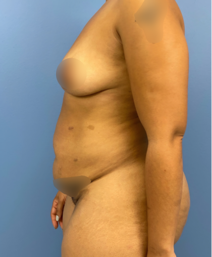Tummy Tuck Before & After Patient #15911