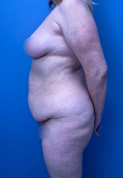 Lower Body Lift Before & After Patient #15924
