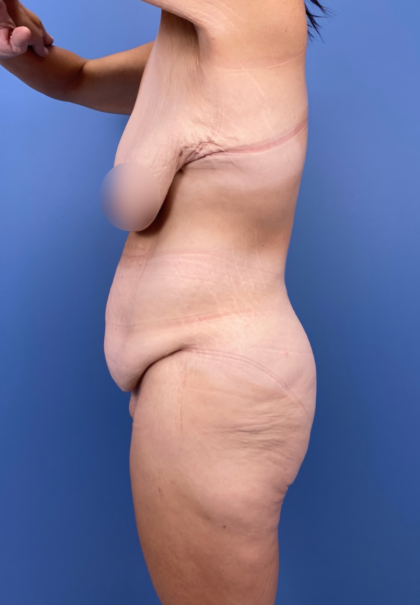Lower Body Lift Before & After Patient #15939