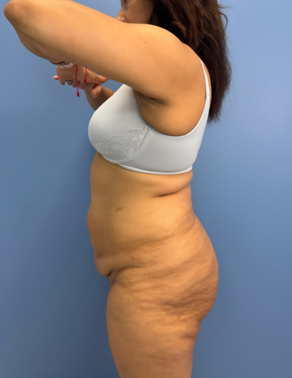 Lower Body Lift Before & After Patient #15802