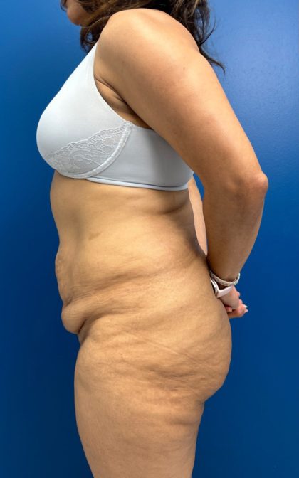 Tummy Tuck Before & After Patient #15804