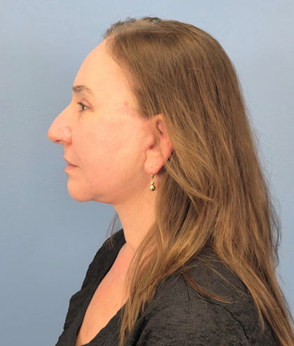 Facial Fat Grafting Before & After Patient #15978
