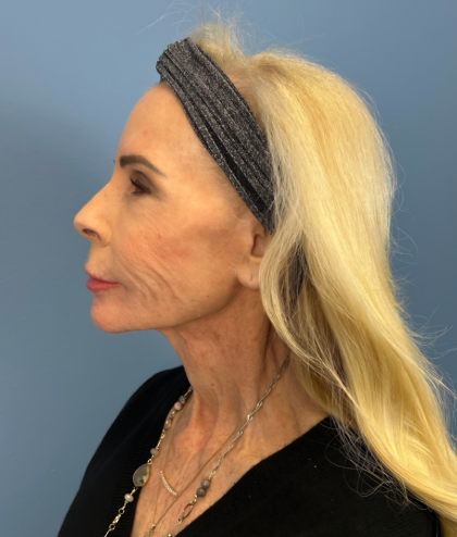 Facial Fat Grafting Before & After Patient #15993