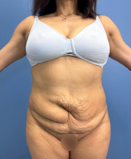 Lower Body Lift Before & After Patient #15802