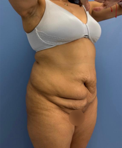 Lower Body Lift Before & After Patient #15802