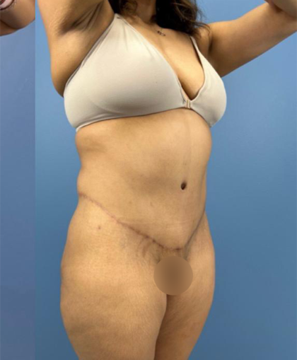 Lower Body Lift Before & After Patient #15802