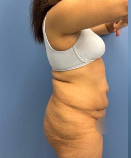 Lower Body Lift Before & After Patient #15802