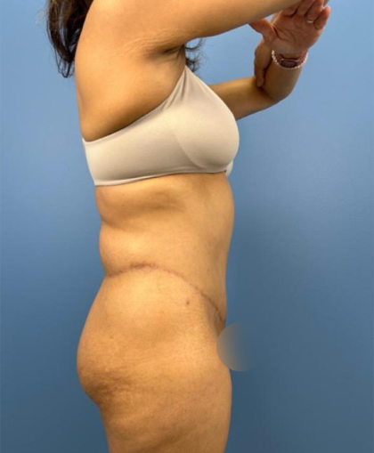 Lower Body Lift Before & After Patient #15802